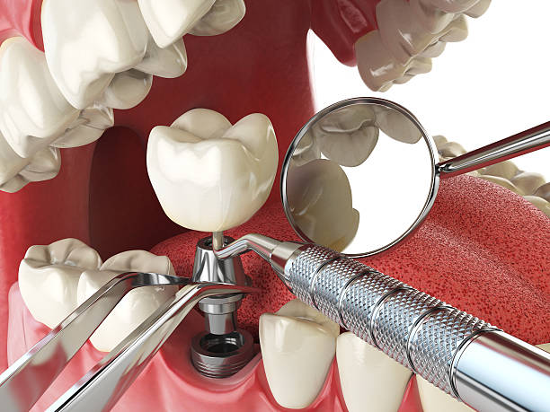 Best Emergency Tooth Extraction in Hurstbourne, KY